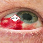Augenveraetzung durch Giftstoffe